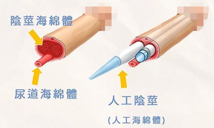 🛠️手術治療：一勞永逸，卻非人人適用